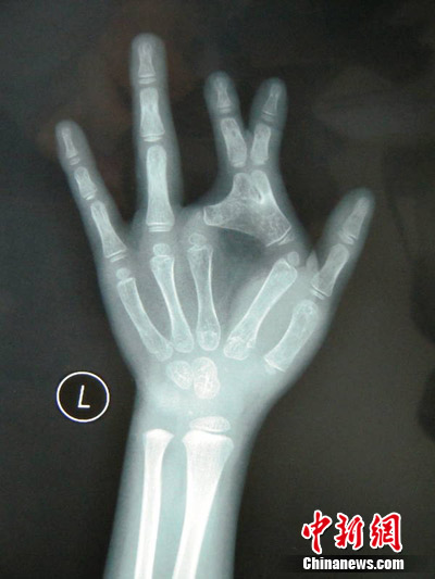 The first joints of her forefinger and middle finger stick together, resembling a pair of scissors.