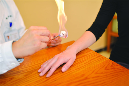 A traditional Chinese medical treatment for warts. Photo: Courtesy of Beijing Dongwen TCM Clinic