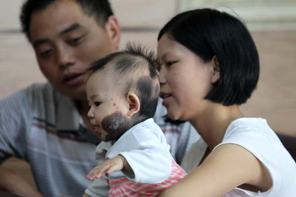 A girl from Fujian province has a congenital disease that causes black birthmarks that will continue to grow over her body and could become cancerous, doctors said. [Zhu Xingxin / China Daily]