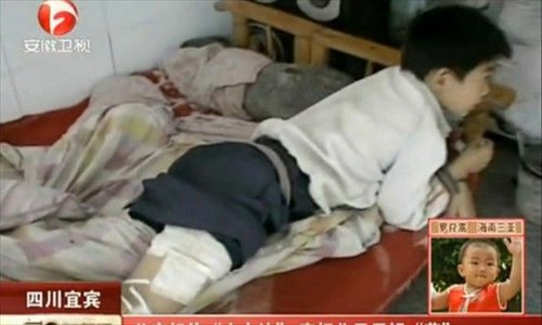 Feifei recovers in Yinbin, Sichuan Province after he slipped into a large pot of boiling medical broth. His father had instructed him to sit on a stool placed in the pot in order to better breathe in the herbal vapor. Photo: people.com.cn