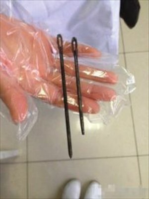 A medical worker displays two iron nails removed from a man's stomach after he intentionally swallowed them during the heat of an argument with his girlfriend two years ago. Photo: Xiaoxiang Morning Herald