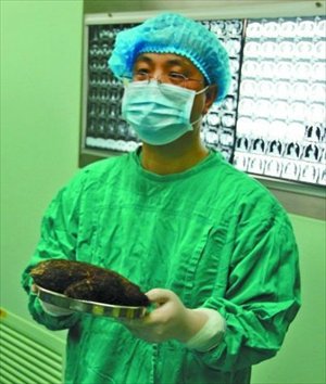 A doctor displays a mass of impacted hair removed from the stomach of a 12-year-old girl at The First Affiliated Hospital of Henan University of Science and Technology in Luoyang, Henan province on January 11. Photo: Dahe Daily