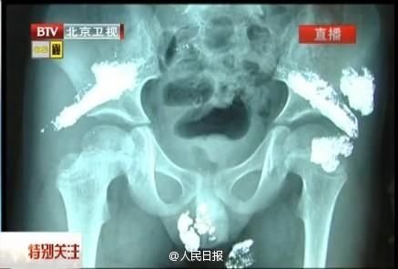 A screenshot from Beijing Television shows the X-ray test result. [Photo/Official Weibo of People's Daily] 