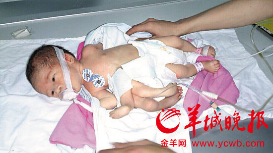 A newborn baby with four arms and four legs has surgery to remove the extra limbs last Friday. [photo / Yangcheng Evening News]