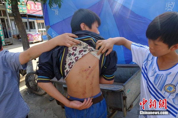 A teenager shows bruises after he was severely beaten by three older men on Sunday. [Photo/CFP] 