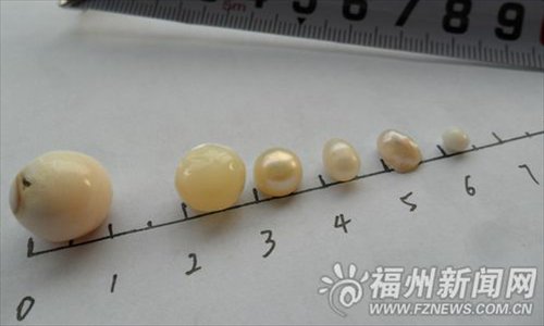 Pictured are six pearls discovered by a woman in a jar of rice in Fuzhou, Fujian province on June 1. Surnamed Lin, the woman claimed she had stored the largest one in a jar containing glutinous rice back in 2005 and found five others inside nine years later. Photo: fznews.com.cn