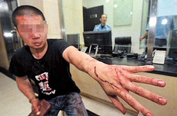 Zhang shows his injuries after being beaten up by a foreigner.  eastday.com 