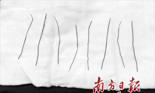 Doctors removed eight straightened paperclips from a man's stomach at Zhujiang Hospital of Southern Medical University in Guangzhou, Guangdong province. The man said he straightened and swallowed the steel clips during quarrel with his wife. Photo: southcn.com