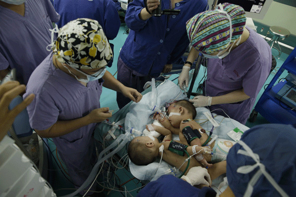 Doctors help the conjoined baby girls get ready for an operation at Shanghai Children's Medical Center on Wednesday. Yin Liqin / for China Daily