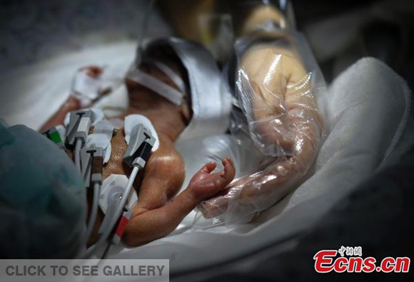 The baby girl, named Li Siyuan, weighs only 660 grams (1.45 ounces) and is 28 centimeters in length. (Photo: ECNS.cn)