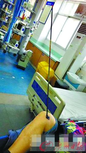 While Wang was hanging clothes on the balcony, he was shot in the knee by an arrow, which came out of nowhere. The arrow sunk 12cm into his knee. [Photo/Guangzhou Daily]