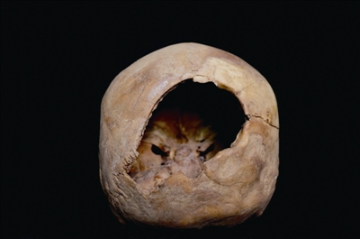 A  perforated female skull discovered at the Xiaohe tomb complex.