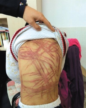 Bruises in the child's back [Photo: weibo]
