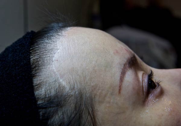 Mi Yuanyuan. a company CEO from Zhejiang province, has a long scar on her forehead and has experienced other side effects after cosmetic surgery in a clinic in South Korea in 2013. (Photo by Feng Zhonghao/For China Daily)