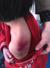 An injury is visible on the shoulder of an 11-year-old girl, who was allegedly seriously beaten by her mother in Lu'an, Anhui province. Provided to China Daily