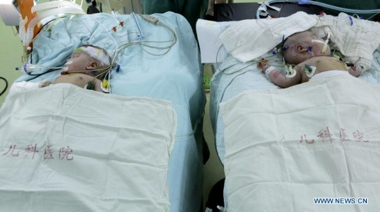 Photo taken on June 9, 2015 shows the successfully separated conjoined twins in east China's Shanghai Municipality. The conjoined twins, who were born on March 17 in east China's Jiangxi Province, were successfully separated Tuesday at the Children's Hospital of Fudan University here in Shanghai. (Photo: Xinhua/Liu Ying)