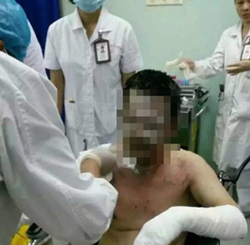 Qin was attacked on Tuesday morning, when a patient poured gasoline on him in a hospital lift and lit it. (Photo/Weibo)