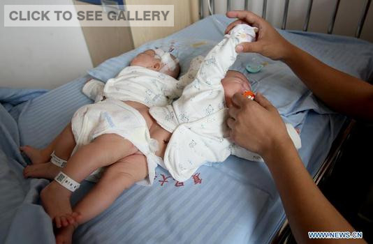 Photo taken on June 9, 2015 shows the conjoined twins to be separated in east China's Shanghai Municipality. (Photo: Xinhua/Liu Ying) 