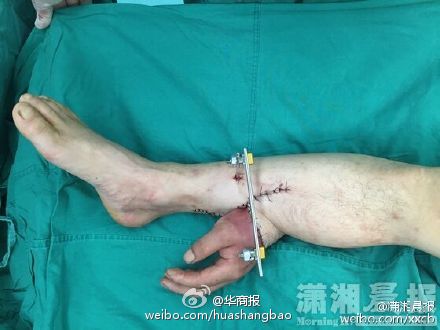 The hand was preserved by being grafted to his leg. (Photo/Weibo)