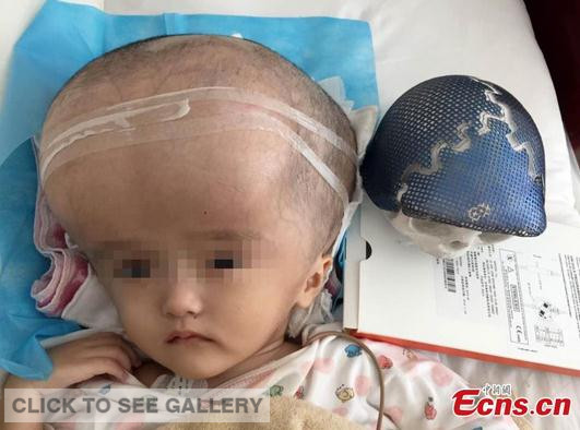 A three-year-old girl with an abnormally large head undergoes surgery at a hospital in Changsha city, capital of Central China's Hunan province, July 15, 2015. The girl suffered from hydrocephalus, a buildup of fluid inside the skull that leads to brain swelling, and her head was four times larger than a normal child of her age. The surgery was successful, according to the hospital.(Photo provided to China News Service)