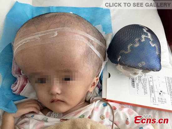 A three-year-old girl with an abnormally large head undergoes surgery at a hospital in Changsha city, capital of Central China's Hunan province, July 15, 2015. (Photo provided to China News Service)