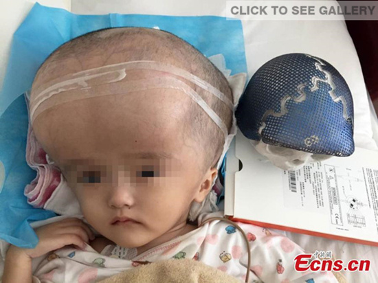 A three-year-old girl with an abnormally large head undergoes surgery at a hospital in Changsha city, capital of Central China's Hunan province, July 15, 2015. (Photo provided to China News Service)