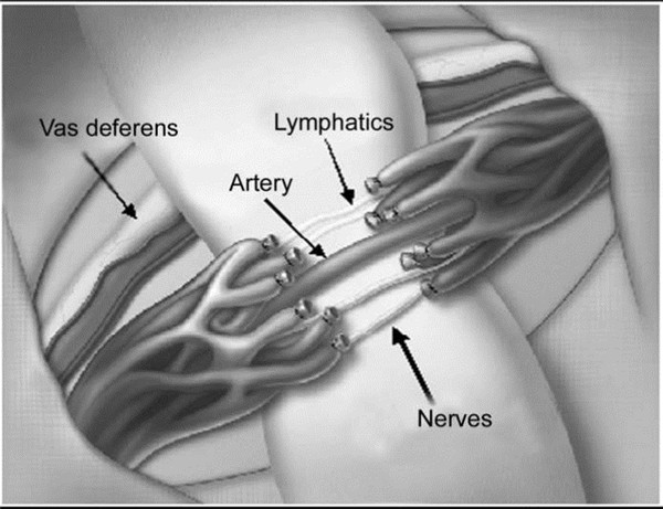 Microsurgical vasoepididymostomy is epididymis tube and vas for anastomosis under surgical microscopy to treat obstructive azoospermia. (Photo provided to chinadaily.com.cn)