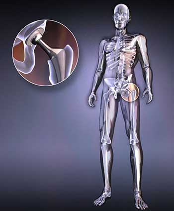 World's first 3D-printed hip joint approved to mass production