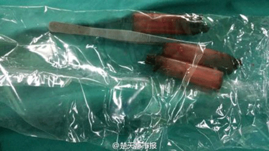 A pair of 10cm tweezers and three lighters were found in Hua's stomach.(Photo from Sina Weibo)