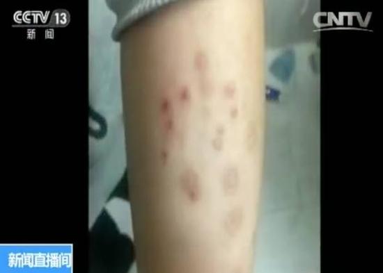 A CCTV News screen grab shows the arm of a sick student. (Photo/Chinadaily.com.cn)