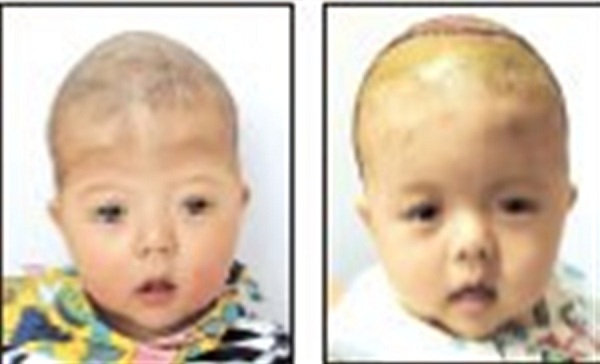 The boy before and after the surgical procedure.(Ti Gong)