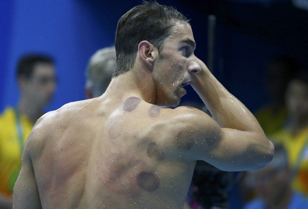 U.S. swimmer Michael Phelps has appeared at the Rio Olympics with purple circles dotting his back and shoulderthe telltale mottling left by the ancient Chinese treatment of cupping. (Photo provided to China Daily)