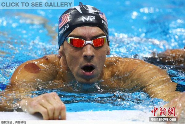 Michael Phelps of the U.S. is seen with red cupping marks on his shoulder and back as he competes in the men's 4 x 100m freestyle relay final at the 2016 Rio Olympics in Rio de Janeiro, Brazil, Aug. 7, 2016. Phelps has adopted a 