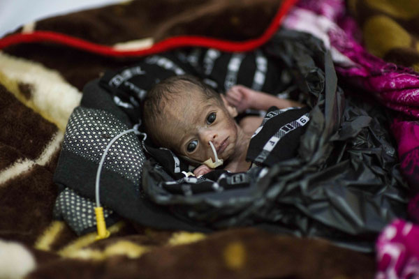 Baby Faadumo, who was born prematurely, is kept warm using a black plastic bag. Photo Provided By UNICEF