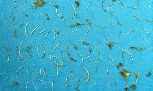 Doctors pull 100 fish bones from old man's anus