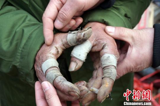 His fingers are full of cuts. [Photo: Zhou Xiaoyun]