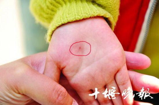 A teacher at a kindergarten in Shiyan, Hubei province, has stirred controversy by poking a students hand with a needle and claiming it was a teaching method. (Photo source: Shiyan Evening News)