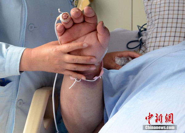 Doctors at a public hospital in Rizhao, Shanodng said Sun Liang suffers from obesity-related diseases such as lymph edema, scrotal swelling, and cutaneous fungal infection. (Photo source: chinanews.com)