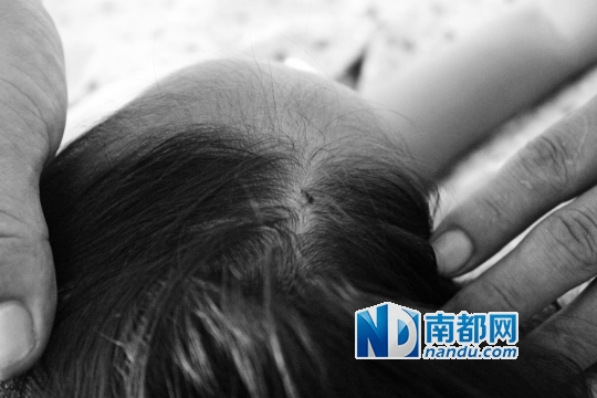 The needle hole on Xiaoman's head. (Photo: Nandu.com)