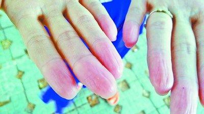 A file photo shows a pair of hands with no fingerprints on any of the 10 fingers. (Photo/Xiamen Daily)
