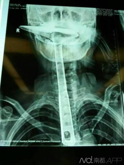 A X-ray photo shows a 30cm-long spatula in a woman's esophagus. (Photo/Southern Metropolis Daily)