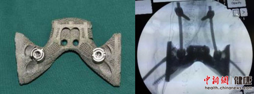 A 3D-printed sacrum is used to help treat sacrum cancer at Peking University People��s Hospital. (Photo/Chinanews.com)