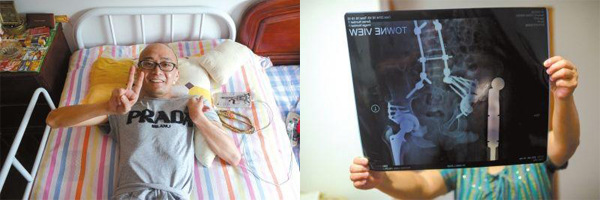 This combo photo shows Hu Yongsheng, a man suffering from Pheochromocytoma for 17 years, and the X-ray photo of his body. (Photo/Beijing Times)