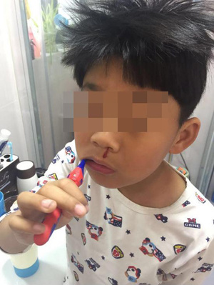 A boy has nosebleed while brushing his teeth. (Photo from Video screenshot)