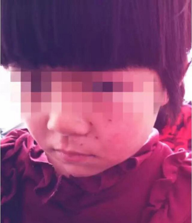Little girl Xiaoxiao (pseudo) was poked in the face by a teacher of an extracurricular class, Nov. 17, 2016. (Photo/dahe.cn)