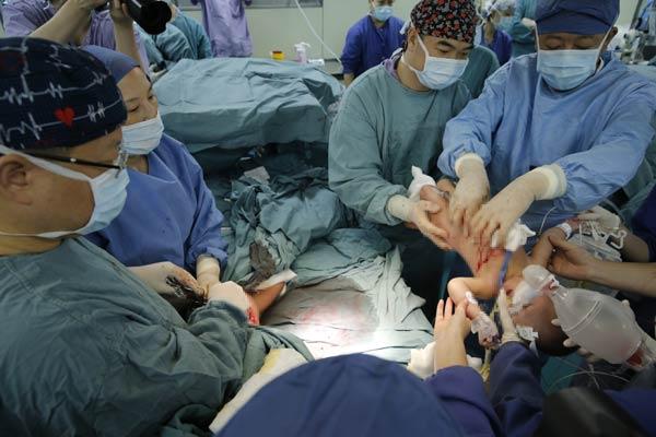 Conjoined twins separated in Shanghai