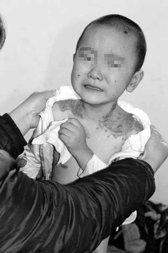 Zining was born with pigmented nevidark-colored, often hairy patches of skinall over his body.