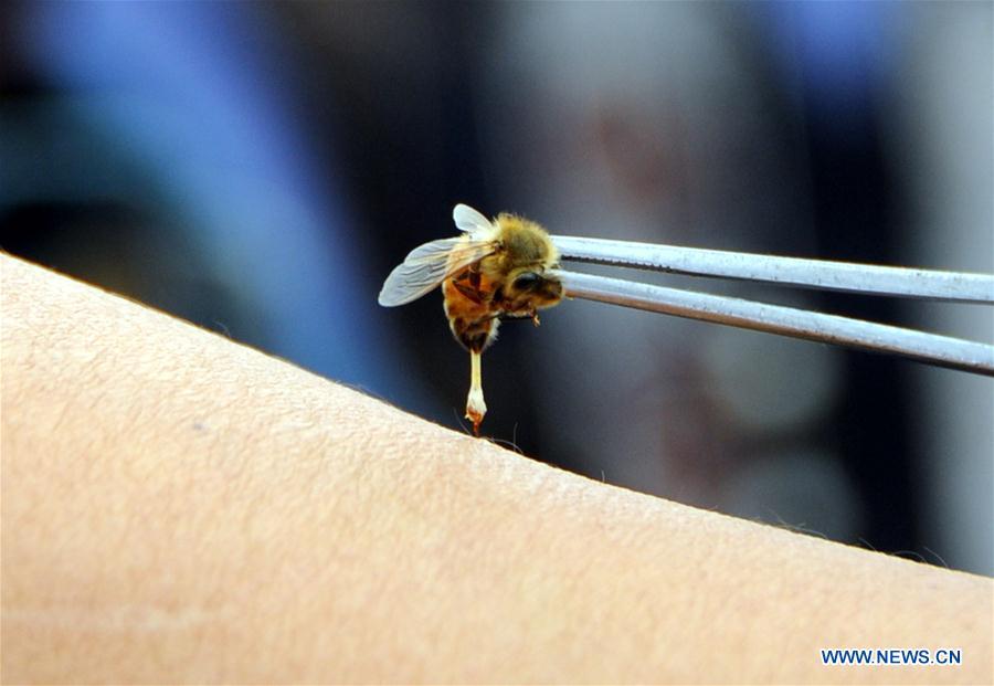 File photo taken on Sept. 20, 2010 shows bee-sting therapy, a kind of traditional Chinese Medicine practice using honey bee for treatment, in Shijiazhuang, capital of north China\'s Hebei Province. Traditional Chinese medicine (TCM), one of the world\'s oldest forms of medicine with different practices including acupuncture, bee-sting therapy, cupping, moxibustion, scrapping, tui na (Chinese therapeutic massage), still prevails in the modern society after thousands of years of evolution, during which generations have restored and maintained health depending on it. The World Health Organization disease index was updated to include references to traditional Chinese medicine for the first time in June 2018. (Xinhua/Gong Zhihong)