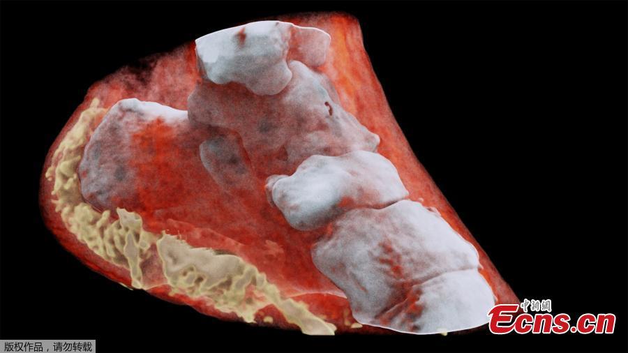 This picture released on July 12, 2018 by MARS Bioimaging Ltd shows a 3D image of left view of an ankle with bones in white and soft tissue in red. 
New Zealand scientists has done the first-ever 3-D, colour X-ray on a human, using a technique promising to improve the field of medical diagnostics, announced Europe\'s CERN physics lab which contributed technology.  (Photo/Agencies)