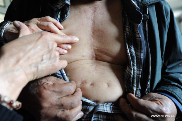 Li Chen, a Japanese abandoned chemical weapon victim, shows a surgery scar during a hearing event in Harbin, capital of northeast China's Heilongjiang Province, April 29, 2014. (Xinhua/Wang Song)